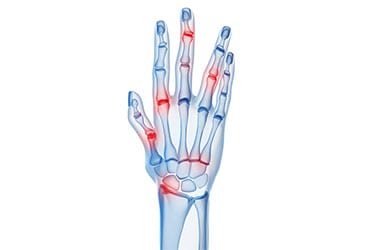 Arthritis Los Angeles Orthopedic Group Thumb - Conditions