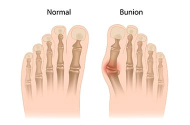 Bunions Los Angeles Orthopedic Group Thumb - Conditions