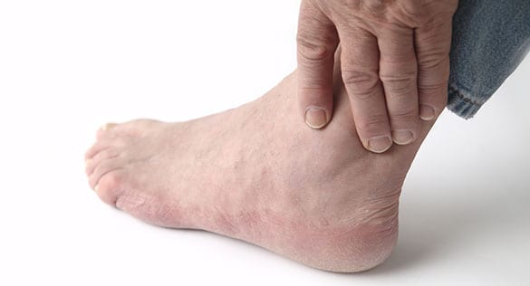 Chronic Ankle Instability Los Angeles Orthopedic Group 1 - Chronic Ankle Instability