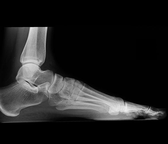 Chronic Ankle Instability Los Angeles Orthopedic Group 3 - Chronic Ankle Instability
