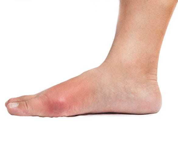 Gout Los Angeles Orthopedic Group 2 - Gout
