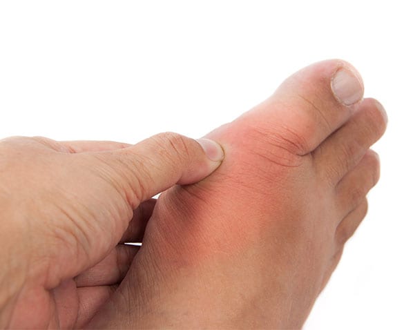 Gout Los Angeles Orthopedic Group 3 - Gout