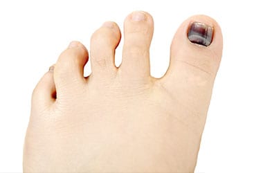 Hammertoes Los Angeles Orthopedic Group Thumb - Conditions
