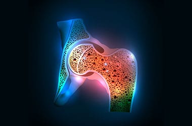 Osteoporosis Los Angeles Orthopedic Group Thumb - Conditions