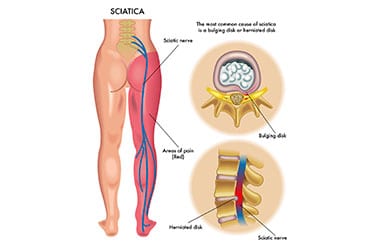 Sciatica Los Angeles Orthopedic Group Thumb - Conditions