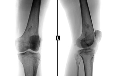 Soft Tissue Bone Tumors Los Angeles Orthopedic Group Thumb - Conditions