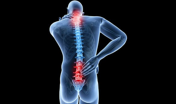 Spinal Stenosis Los Angeles Orthopedic Group 1 - Spinal Stenosis