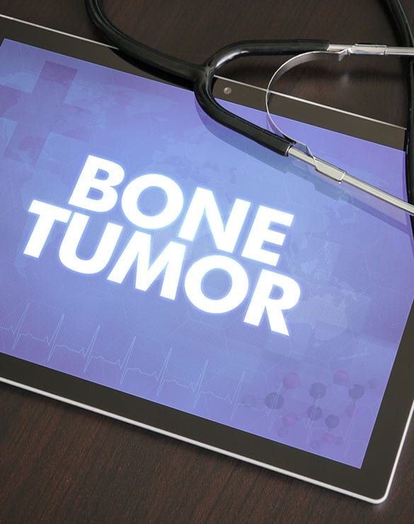 Soft Tissue Bone Tumors Los Angeles Orthopedic Group 3 - Soft Tissue & Bone Tumors