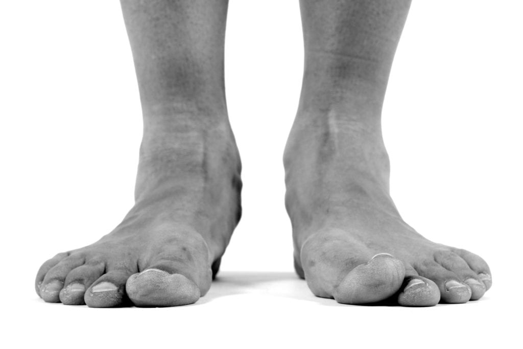 flat foot reconstruction surgery recovery protocol