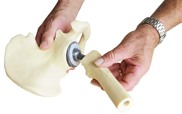Total Joint Replacement Los Angeles Orthopedic Group 1 - Total Joint Replacement