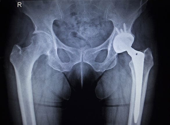 Total Joint Replacement Los Angeles Orthopedic Group 2 2 - Total Joint Replacement