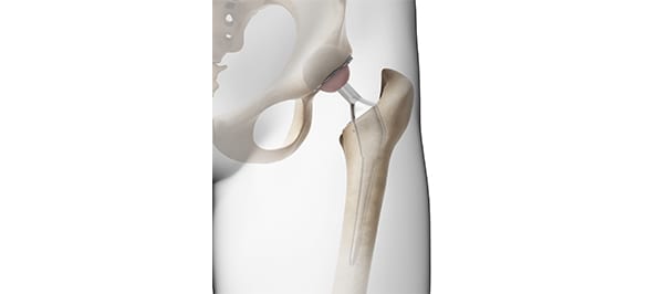 Total Joint Replacement Los Angeles Orthopedic Group 3 - Total Joint Replacement