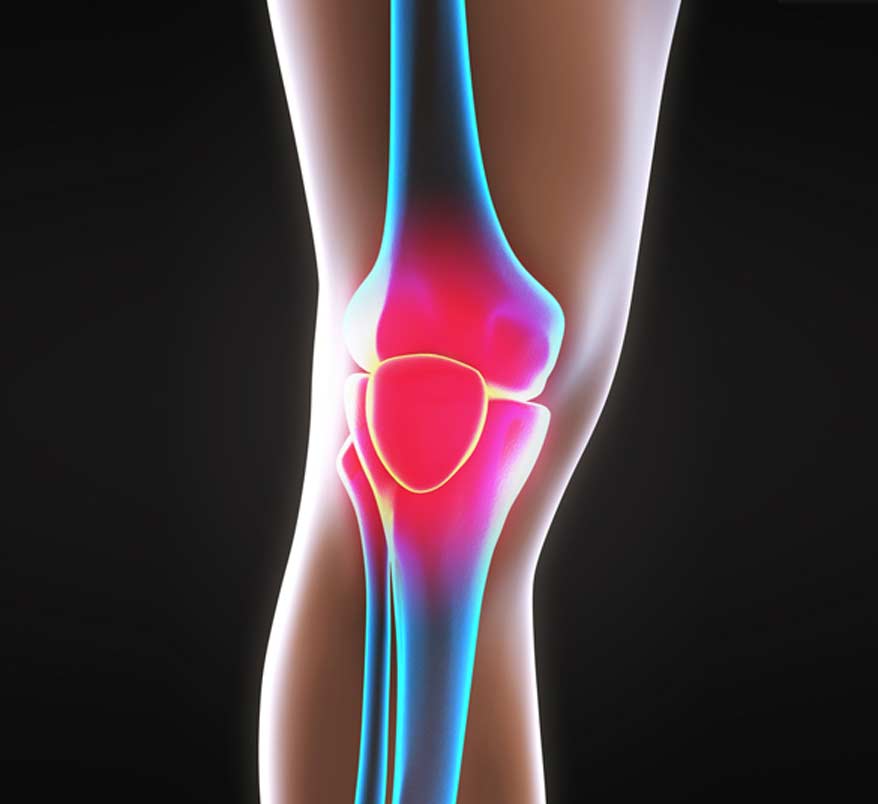 medical concept of knee pain in need of knee surgery Los Angeles Orthopedic Group - Knee Surgery